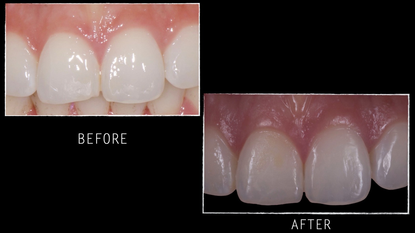 Cosmetic dentistry case by Dr. Seema